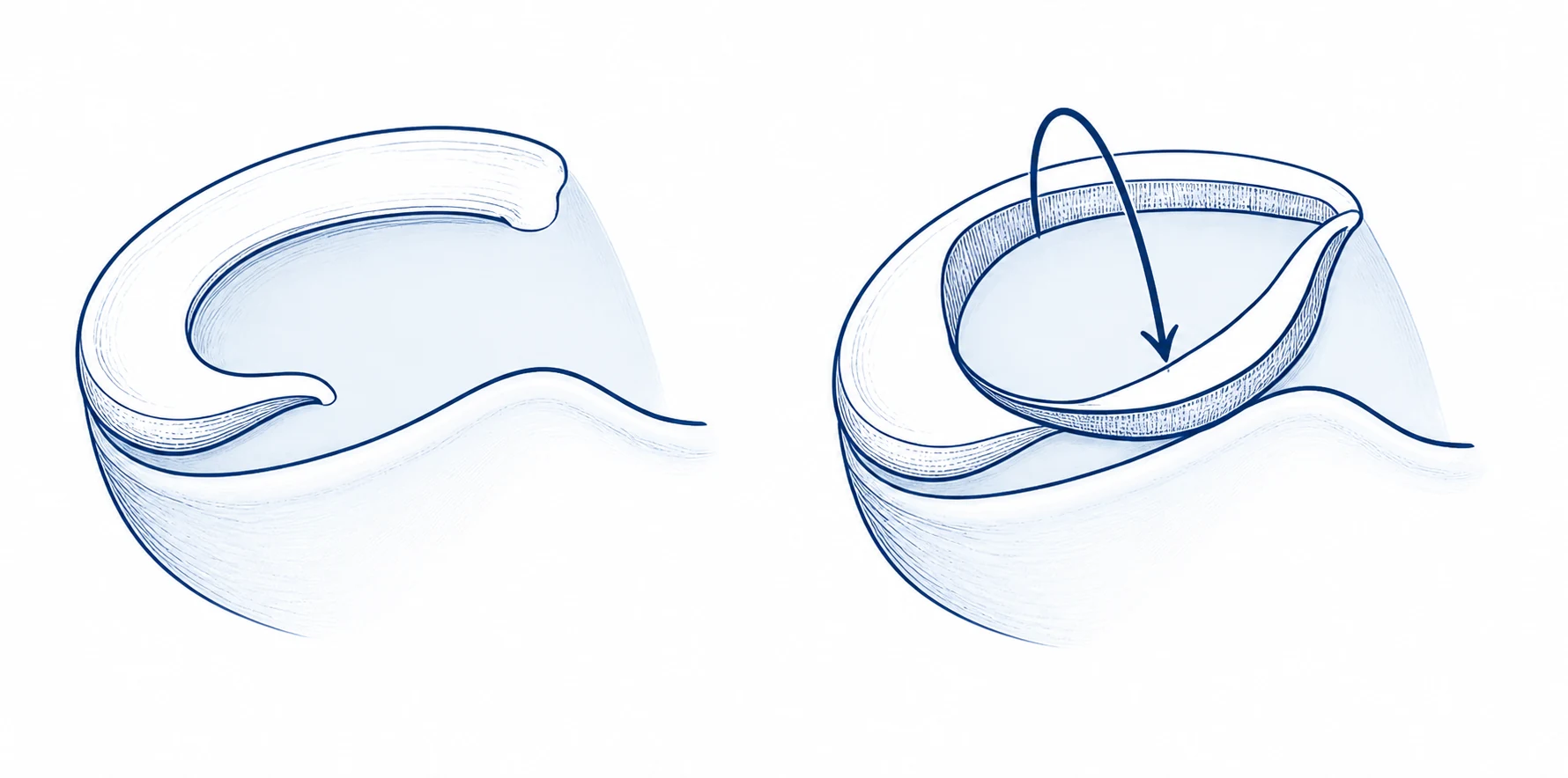 Cross-section comparing a normal meniscus with a bucket-handle meniscal tear folded inward