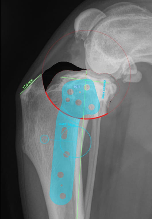 TPLO planning radiograph with implant overlay