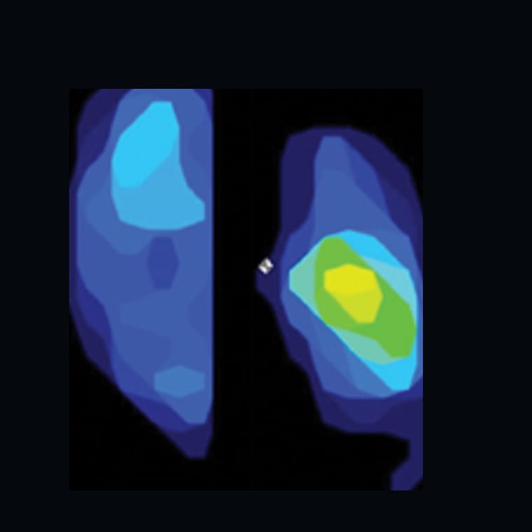 Pressure map from a knee after TPLO