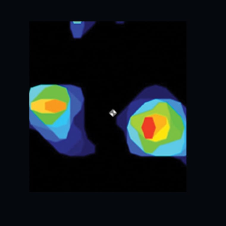 Pressure map from a cruciate-deficient knee