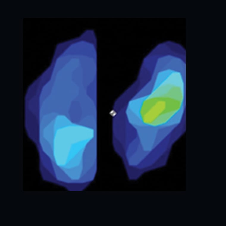 Pressure map from a knee with an intact cruciate ligament