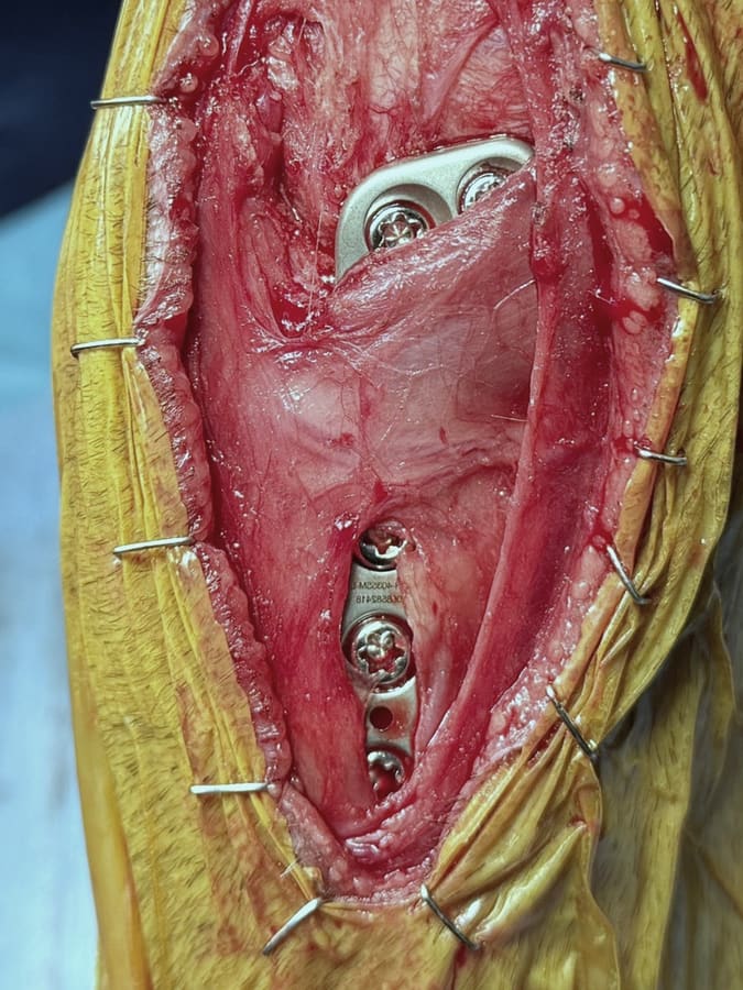 Muscle-sparing TPLO approach preserving muscle attachments over the upper tibia