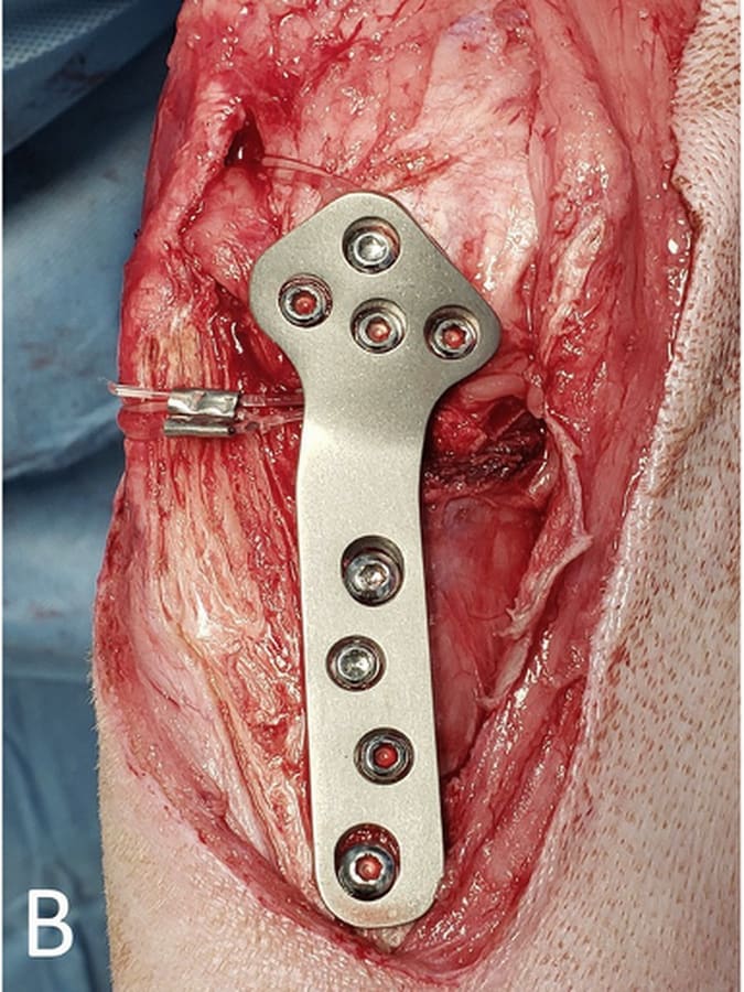 Reference image of traditional TPLO exposure with more of the muscle attachment elevated around the upper tibia